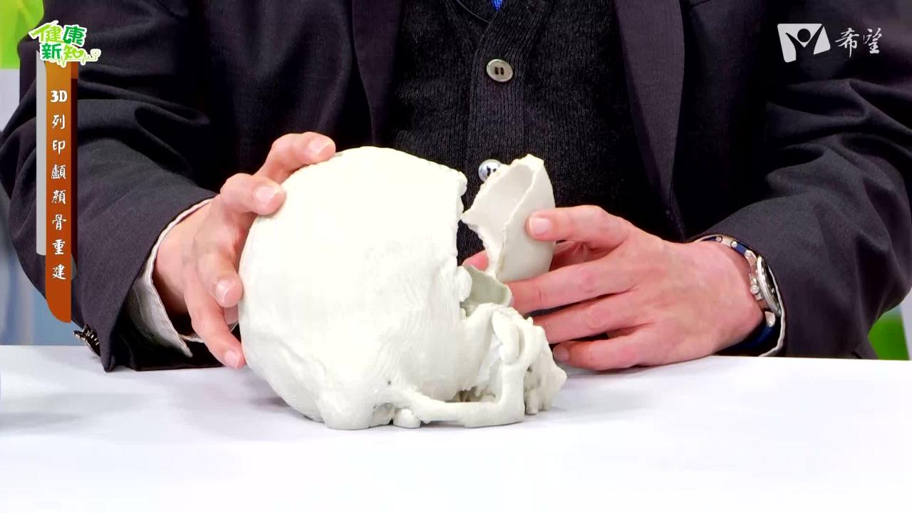 561. 3D列印顱顏骨重建